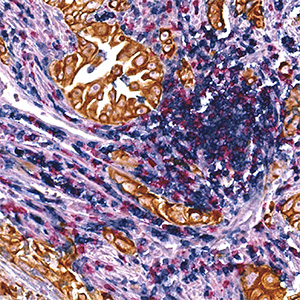 Lung Adenocarcinoma: CD4, CD8, PanCK.